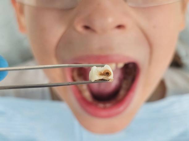 Best Emergency Dental Care for Broken or Chipped Teeth in Willmsburg, IA